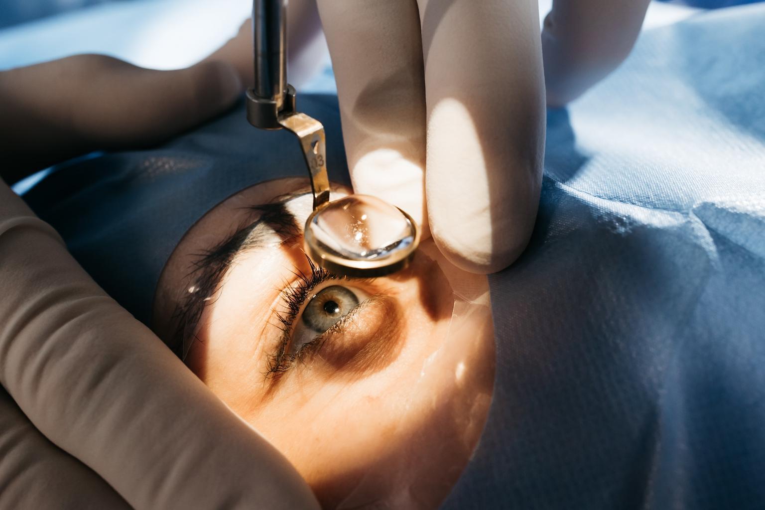 Laser eye surgery procedure